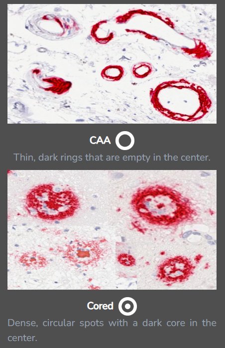 The Examples panel showing CAA and cored plaque reference images.