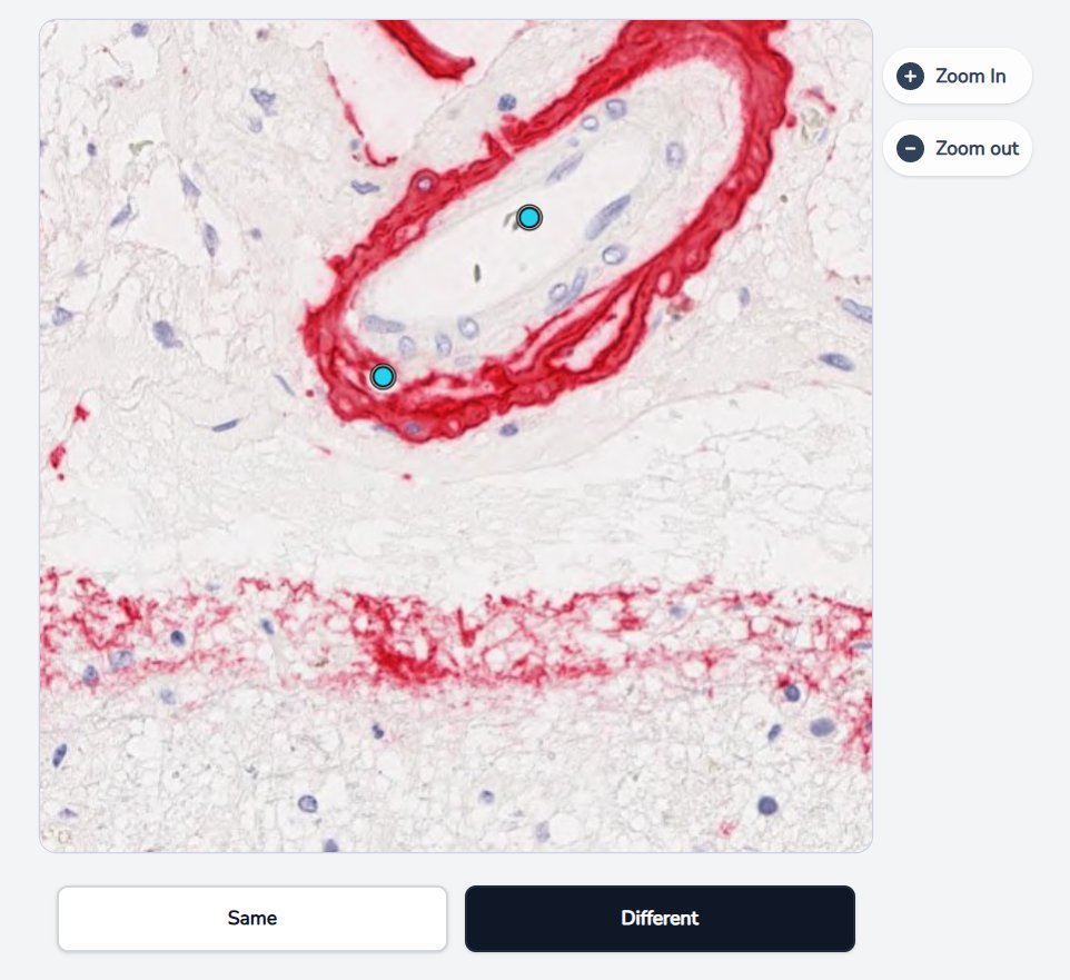 Two dots on the same ring-shaped lesion.